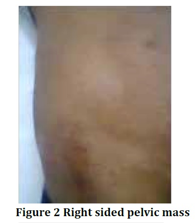 Dermatofibrosarcomaprotuberans
