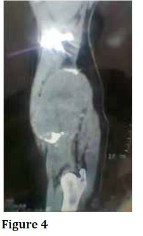 Dermatofibrosarcomaprotuberans