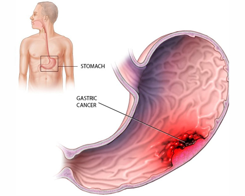 Gastrointestinal cancer