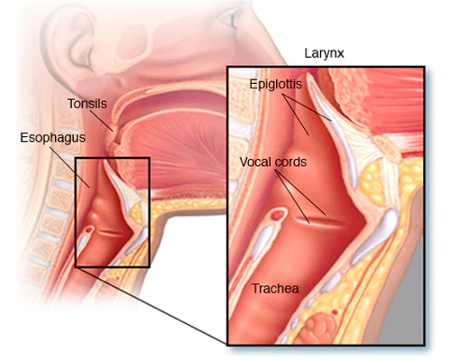 throat cancer