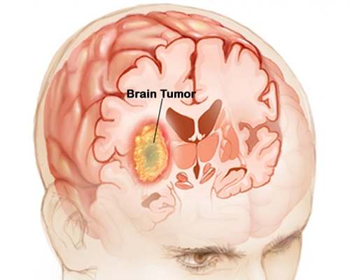 brain tumor